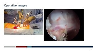 Technical Feasibility and Safety of Transpedicular Thoracic Corpectomy forCircumferential Decompression of Spinal Cord From Renal Cell Metastasis Using BiportalEndoscopic Technique: An Argument for the Paradigm Shift in Separation Surgery?