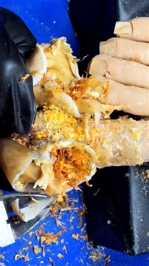 Ingrown Toenail Removal Treatment | Step-by-Step Cleaning Process | CTH F1