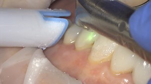 Laser Crown Removal