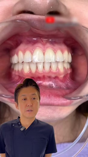 リテーナーの必要性と使用法