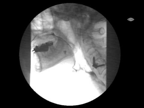 Modified Barium Swallow Test