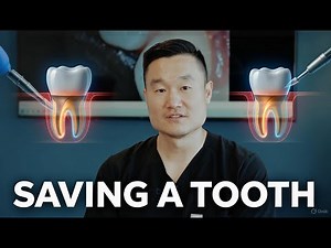 Saving a Dying Tooth: Full Root Canal Treatment + Post & Core Procedure Step by Step
