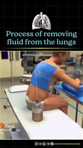 4.4K views | Removing fluid from the lungs is a careful medical process that helps a patient breathe easier 贈✨ and prevents serious complications. It’s done only by trained professionals using safe, step-by-step techniques to drain the excess fluid and reduce pressure on the lungs. 喙六‍⚕️ #lunghealth #medicalprocedure #thoracentesis #respiratorycare #doctorlife #healthawareness #share #helthcare | The Doctorpreneur Academy | Facebook