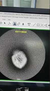 MRI brain shows cerebral atrophy, leucodystrophy, corpus callosum dysgensis Dr Nasser Dr Rabab