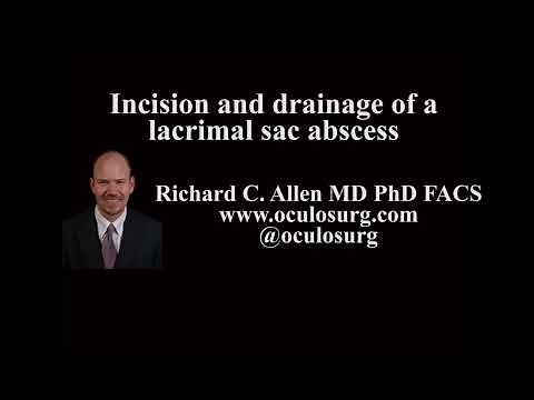 Incision and drainage of a lacrimal sac abscess