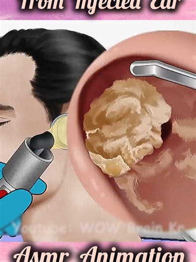 Satisfying ASMR Ear Wax & Insect Removal 👂🧼 | Deep Cleaning & Care Treatment 🚀 #asmr #earcleaning #satisfyingvideo #fyp #oddlysatisfying