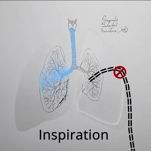 Pneumothorax Treatment explained in 1 minute