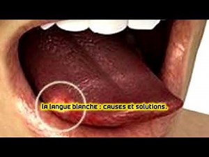 La langue blanche : causes et solutions