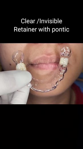 Amazing Transformation with Invisible Teeth Retainer