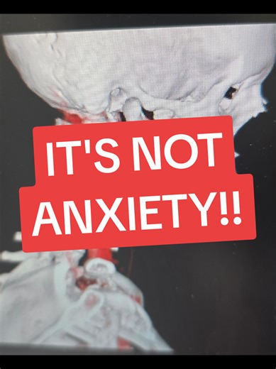 The styloid process is small. But if it’s elongated, it can press on nerves and blood vessels. That’s Eagle Syndrome. Rare. Overlooked. Real. #eaglesyndrome #misdiagnosed #raredisease #medicalgaslighting #healthtok