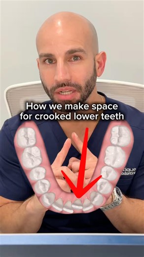 Do I need my tooth extracted to straighten my lower teeth with Invisalign? ￼