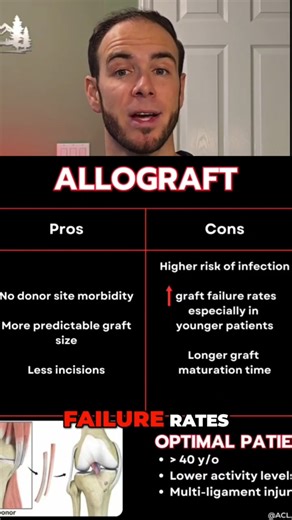 ACL Surgery - Allograft