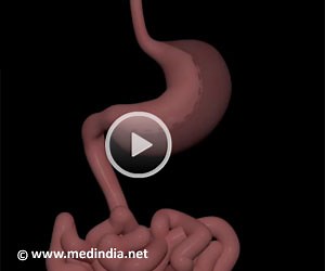 Health Animation - Weight Loss Surgery - Sleeve Gastrectomy