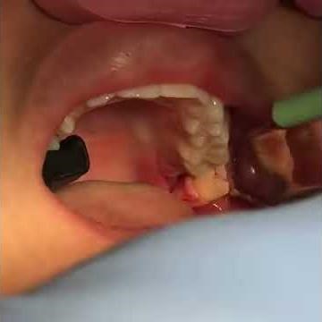 4 Wisdom Teeth Removal Surgery
