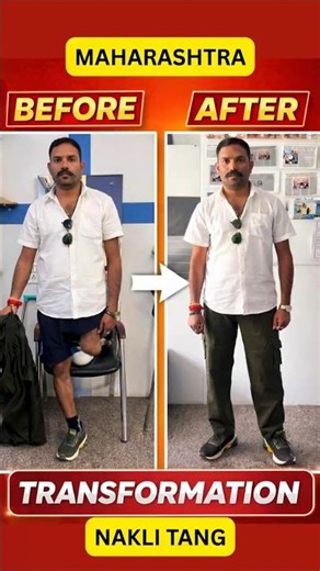 Above knee Artificial Leg Price | Best Prosthetic Leg | Above knee Amputee #ossur #ottobock #ampute