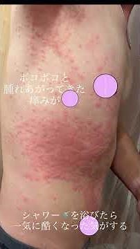 草刈り作業 漆かぶれ 毛虫 右上半身激痒み 感染2〜3目激しい痒みに襲われる