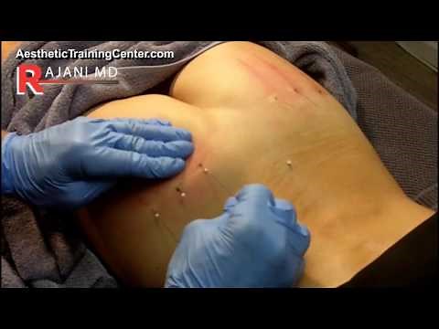 Butt Lift PDO // Threads and Sculptra Explained Dr Rajani