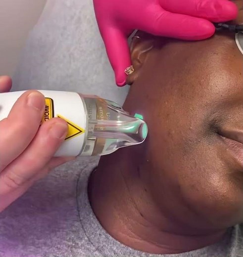 Treating Folliculitis and Hyperpigmentation With Laser Hair Reduction by the Lumenis Splendor X