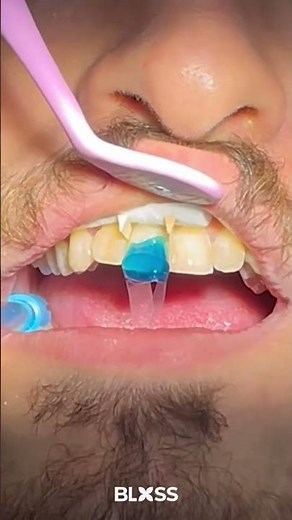 Blue Gel for Stronger Bond! 💙 | Tooth Etching Before Filling