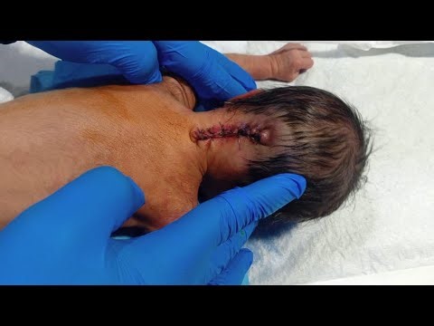 MMC Patient Wound Dressing | Safe & Sterile Procedure