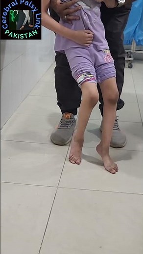 CP CLINICAL SIGNS / Ankle Clonus in a standing posture having Spastic diplegia