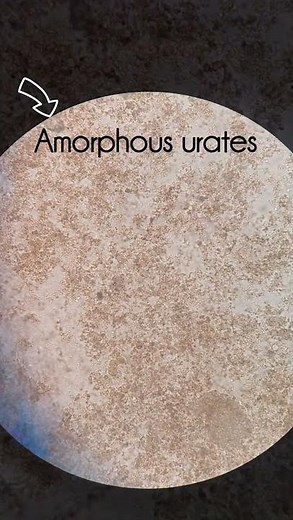 Amorphous urates in urine #bacteria #microscope #urine #dailyshorts #viralvideo #youtubeshorts