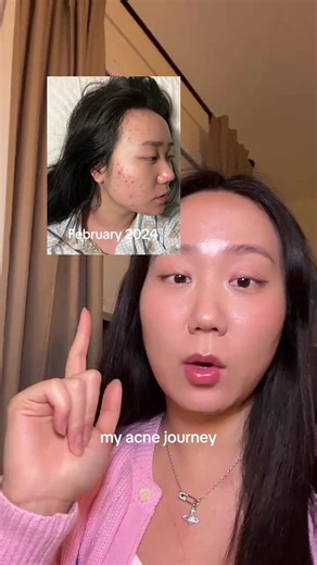 Mi viaje de cuidado de la piel: ¿por qué no funcionó Tret?