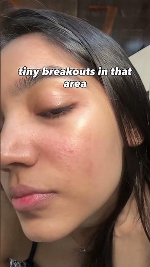 LARGE CLOGGED PORES ON FACE ‼️ check description #acne #cloggedpores #largepores #acnetips