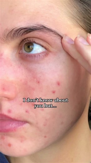 A glimpse of hope for you 🤍 #acne #acnefighter #acnepositivity #acnejourney #acnejourneytoclearskin #acnetransformation