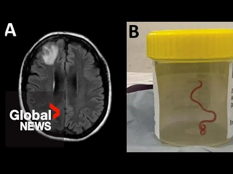 Doctors pull wriggling 8-centimetre live worm from patient’s brain during surgery