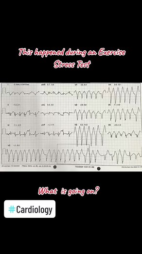 Exercise Stress Test Insights: Doctor's Perspective