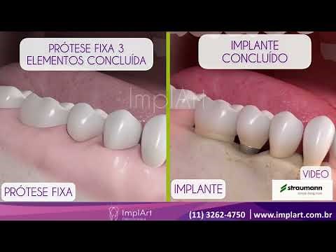 DIFERENÇAS ENTRE IMPLANTE DENTÁRIO E PRÓTESE FIXA ‪@ClinicaImplArtImplanteDentario‬