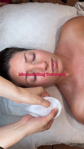 Microneedling is SO satisfying. 🙌🏻🤍 #microneedling #asmr #esthetician #collageninductiontherapy | maxandwell_