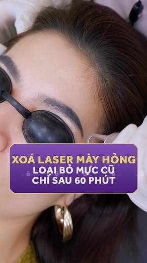 Laser xoá mày công nghệ cao, mờ mực ngay chỉ sau 60 phút. Ưu đãi cực hấp dẫn giảm đến 65% khi đăng ký tại đây! #lamdep #thammylinhanh #laser #laserchanmay #chanmay #chanmayphongthuy