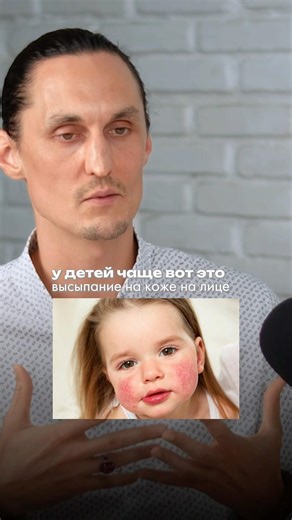 WHY DO YOUNG CHILDREN HAVE ACNE? 👆