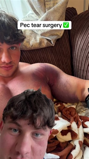 Pec Tear Surgery Recovery Journey: What to Expect