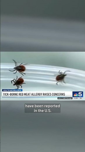 Doctors warn of rare red meat allergy caused primarily by tick bites