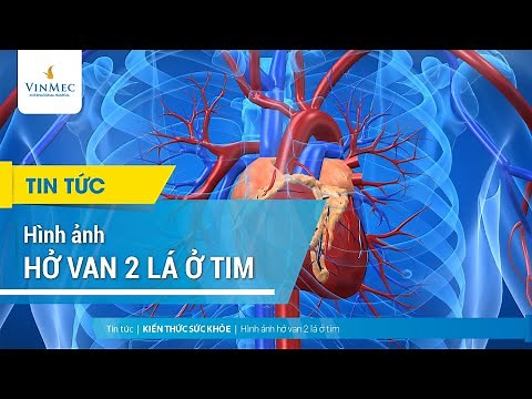Hình ảnh hở van 2 lá ở tim
