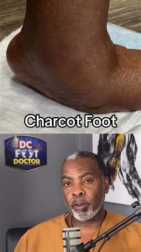 Charcot Foot #podiatry #charcotfoot #diabetes