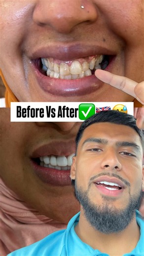 #agadir #uk #manchester #teeth #veneers