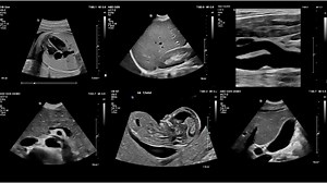 General imaging ultrasound