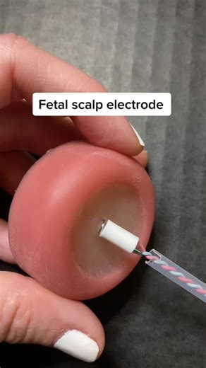 FSE: fetal scalp electrode