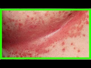 Symptome und Behandlung für Candidiasis unter der Brust