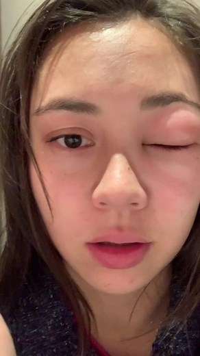 Expectation vs. reality 🐝 #stitch @Erika Thompson #beetok #bees #beesting