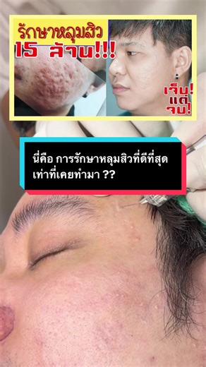 การรักษาหลุมสิว ที่ดีที่สุดเท่าที่เคยทำมา ? #juvgen #รีวิวหลุมสิว #รักษาหลุมสิวที่ดีที่สุด #รักษาหลุมสิวถาวร #มิราเบลหลุมสิว
