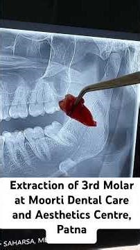 Extraction of Impacted 3rd Molar #dentist #extraction #doctor #moortidentalcare #patna #dentalcare