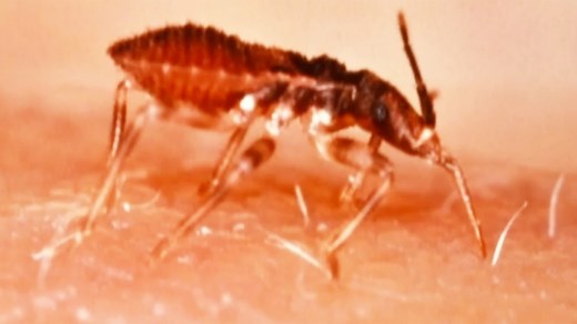 'Kissing Bugs' Spreading Painful Bites Across US