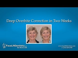 Deep Overbite Correction in Two Weeks