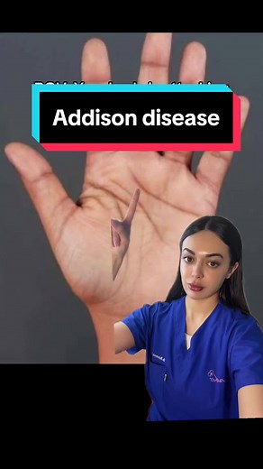 Understanding Addison's Disease: Causes, Symptoms, and Treatment