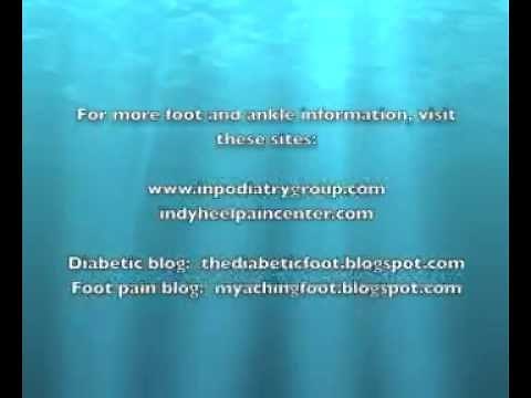 Can I Still Walk Normally After A Toe Amputation